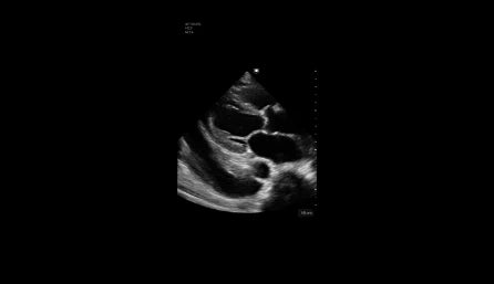 Pleural Effusion 2